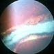 Laser barrier at the edge of a melanoma before excision? Laser barrier at the edge of a melanoma before excision?